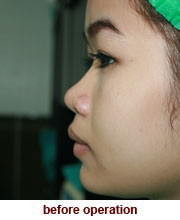 plastic_surgery_augmentation_rhinoplasty